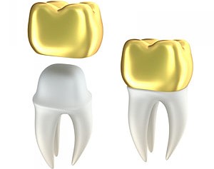 Золотые коронки для зубов